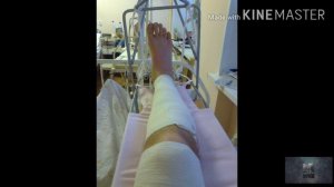 Как я сломал ногу когда был маленький 🧒