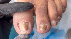 Грибок ногтей / Как его зачищать? /Лечение грибка ногтей в домашних условиях #грибок #грибокногтей