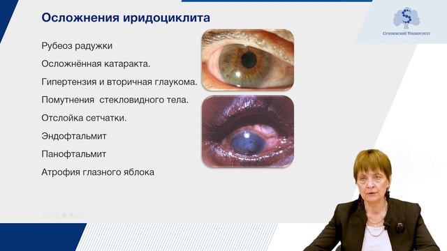 Синдром «красного глаза». Заболевания роговицы и сосудистой оболочки. Часть 1