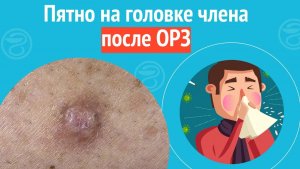 ? Пятно на головке члена после ОРЗ. Клинический случай №1061