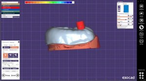 EXOCAD Индивидуальная ложка для имплантов