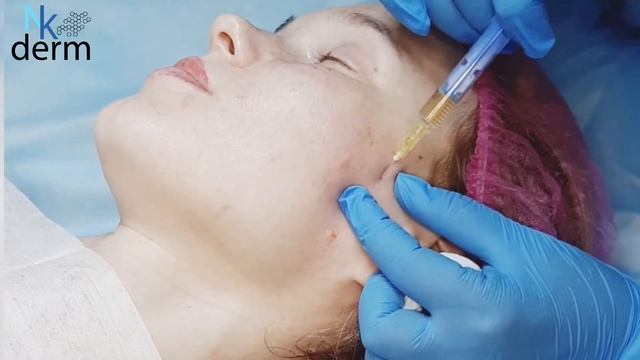 Проведение процедуры плазмолифтинга, на видео показаны все этапы!