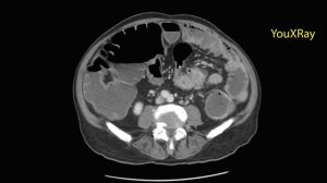 Кишечная непроходимость на КТ