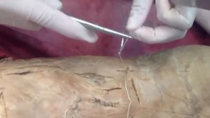 Шов Донати.