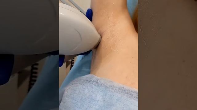 Эпиляция диодным лазером смотреть онлайн