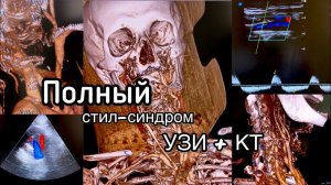 Полный стил-синдром. Диагностика на УЗИ и КТ. Болезнь Такаясу.