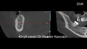 Инородное тело.Пломбировочный материал в костной ткани. Область 47 зуба.#ятрогения