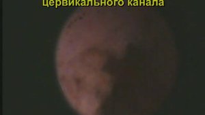 Эндоцервикс. Гиперплазия слизистой оболочки.
