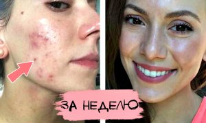 Самое дешёвое и эффективное средство от прыщей в мире! Как применять хозяйственное мыло от прыщей?