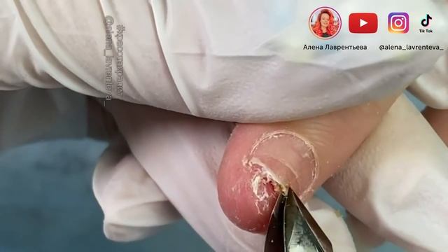 Преображение ❤️ Как восстановить ноготь после травмы ? 2 серия ?
