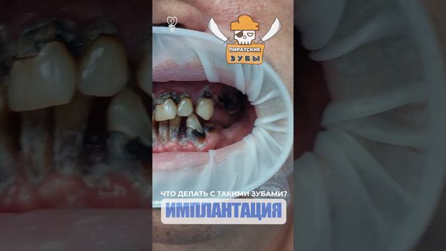 Зубы пирата. Что делать? Pirate's teeth. What to do?