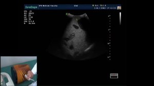 УЗИ селезенки:техника исследования. Проф. В. Изранов