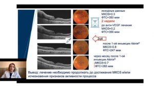 Анти-VEGF терапія макулярного набряку при оклюзії вен сітківки. Ульянова Н.А.