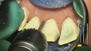 Методика препарирования под коронку Mario Semenza