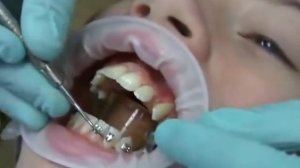 Безлигатурные брекеты керамические брекеты