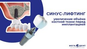 Синус-лифтинг - безопасное и безболезненное увеличение объема костной ткани в "Мега-Дент"