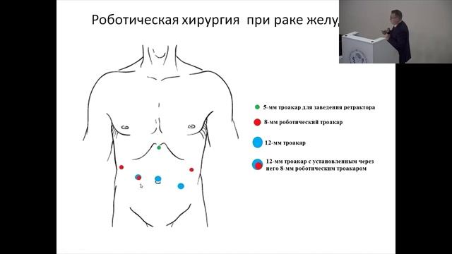 Гладышев Д.В. Взгляд хирурга. Роботическая хирургия рака желудка.