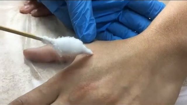Криодеструкция.Техники удаления различных образований кожи с помощью жидкого азота