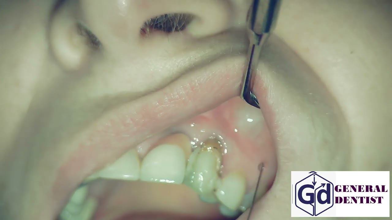 Infiltration anesthesia for treatment  tooth 22.