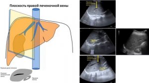 Плоскости ультразвукового  сканирования печени