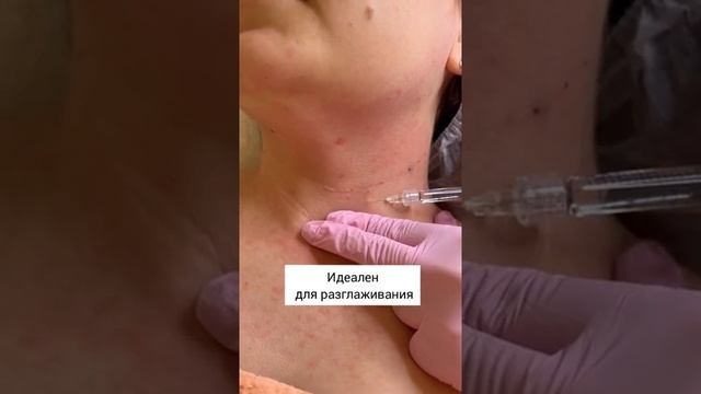 Belotero Soft идеален для разглаживания колец Венеры #москва #косметологмосква #салонкрасотымосква смотреть онлайн