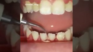 Чистка зубного камня