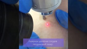 Удаление сосудов неодимовым лазером.mp4
