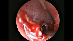 Rzayev R.M. Экссудативный средний отит - эндоскопическое шунтирование барабанной перепонки