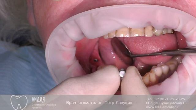 Удаление имплантатов Альфа-Био смотреть онлайн