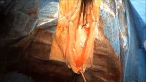 Пластика цистоэнтероцеле 3 ст. собственными тканями. Пластика ректоцеле. Леваторопластика. Голос!