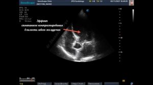 Обширные рубцовые изменения левого желудочка. Рассказ о том, как пациент не заметил у себя инфаркт.