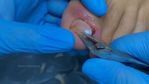 Вросший ноготь у кадета / Врос на ноге / Гранулема / Вросший на пальце / Врос на ноге что делать