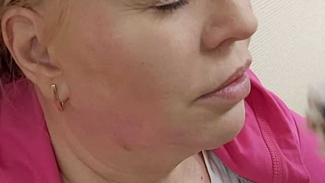 Мезо инъекции. Лифтинг, усушка. Каждые 7 дней. 8 сеансов. Молодость для кожи.