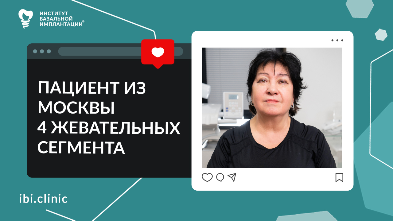 ОТЗЫВ ПАЦИЕНТКИ. Восстановление жевательных Зубов металлокерамическими коронками на имплантатах