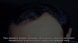 Облысение у мужчин. Как его предотвратить и что делать при облысении?