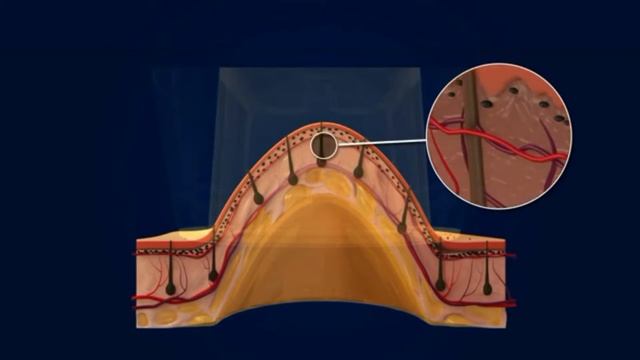 Все о лазерной эпиляции смотреть онлайн