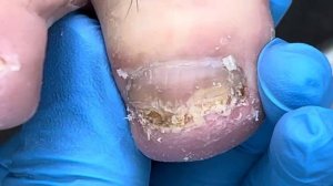 The patient's toenails have not been cut for two months and she needs a pedicure.【Xue Yidao】