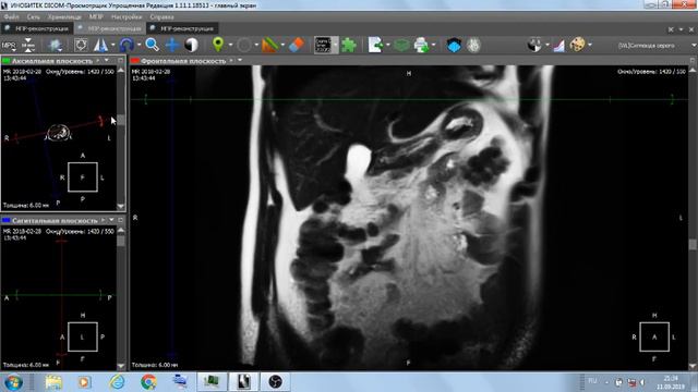 Места пережатия толстой . смотреть онлайн