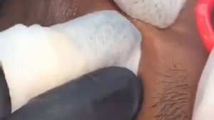 Чистка лица от чёрных точек.