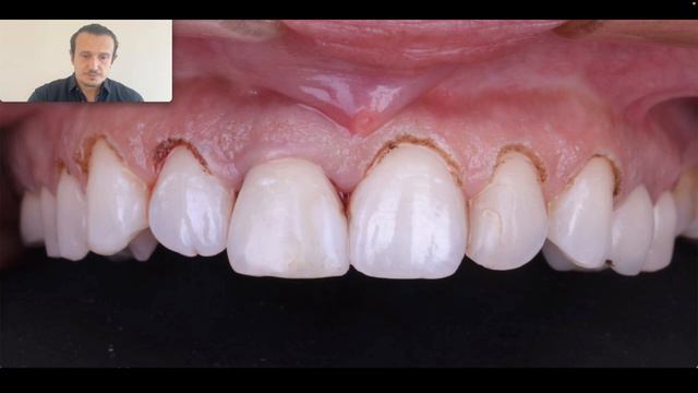 Dr. Ventseslav Stankov_ Immediate Implant Combined with Crown Lengthening