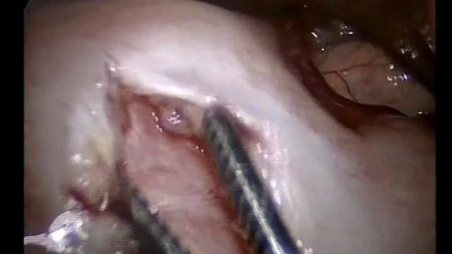 Симультанная операция по поводу врожденного гипертрофического пилоростеноза и паховой грыжи