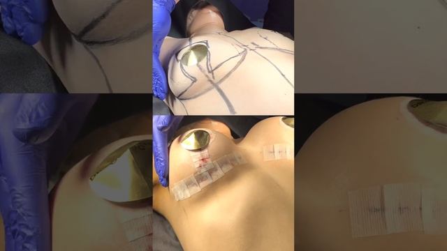 Подтяжка груди До и После смотреть онлайн