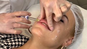 БИОРЕВИТАЛИЗАЦИЯ AQUASHİNE + УВЕЛИЧЕНИЕ ГУБ JUVEDERM/ VLOG # 48