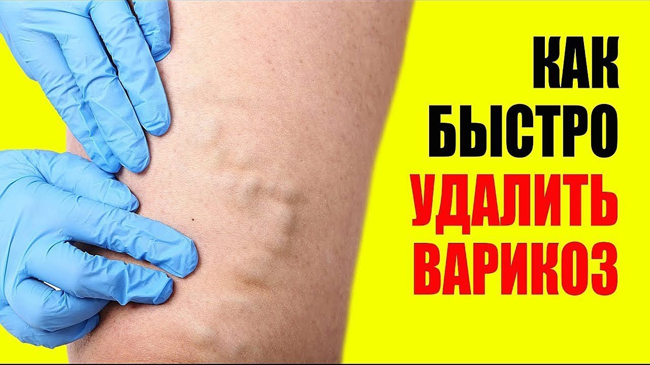 Лечение Варикоза. Симптомы, профилактика, продукты, упражнения