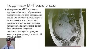 Гигантская шваннома малого таза