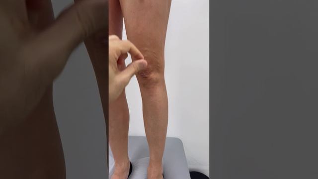 Тазовый варикоз. Варикоза на ногах у девушки. Прием флеболога. Флеболог Москва. Флеболог. Москва смотреть онлайн