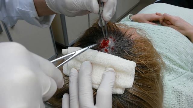 Удаление жировика (атеромы) на голове | – смотреть онлайн видео от ...