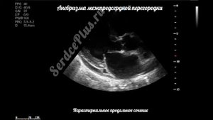 Аневризма МПП с ДМПП на эхокардиографии