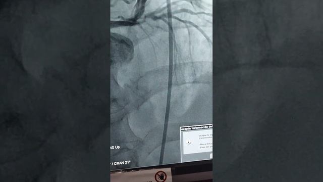 Revascularización Cardiaca. Angioplastia de arteria coronaria descendente anterior con STENT.