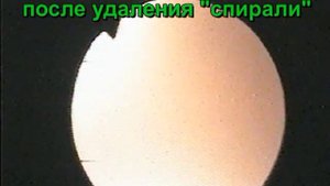 Выпадение спирали из матки в цервикальный канал.